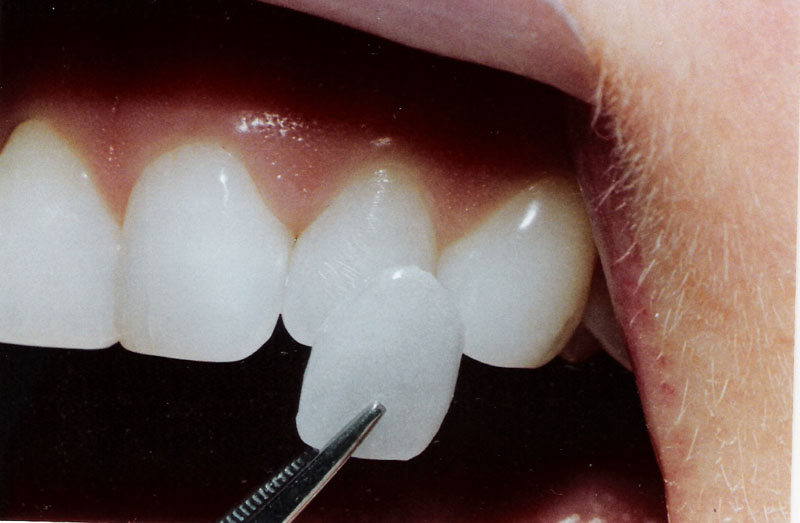 veneer